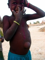Boy with unbilical hernia